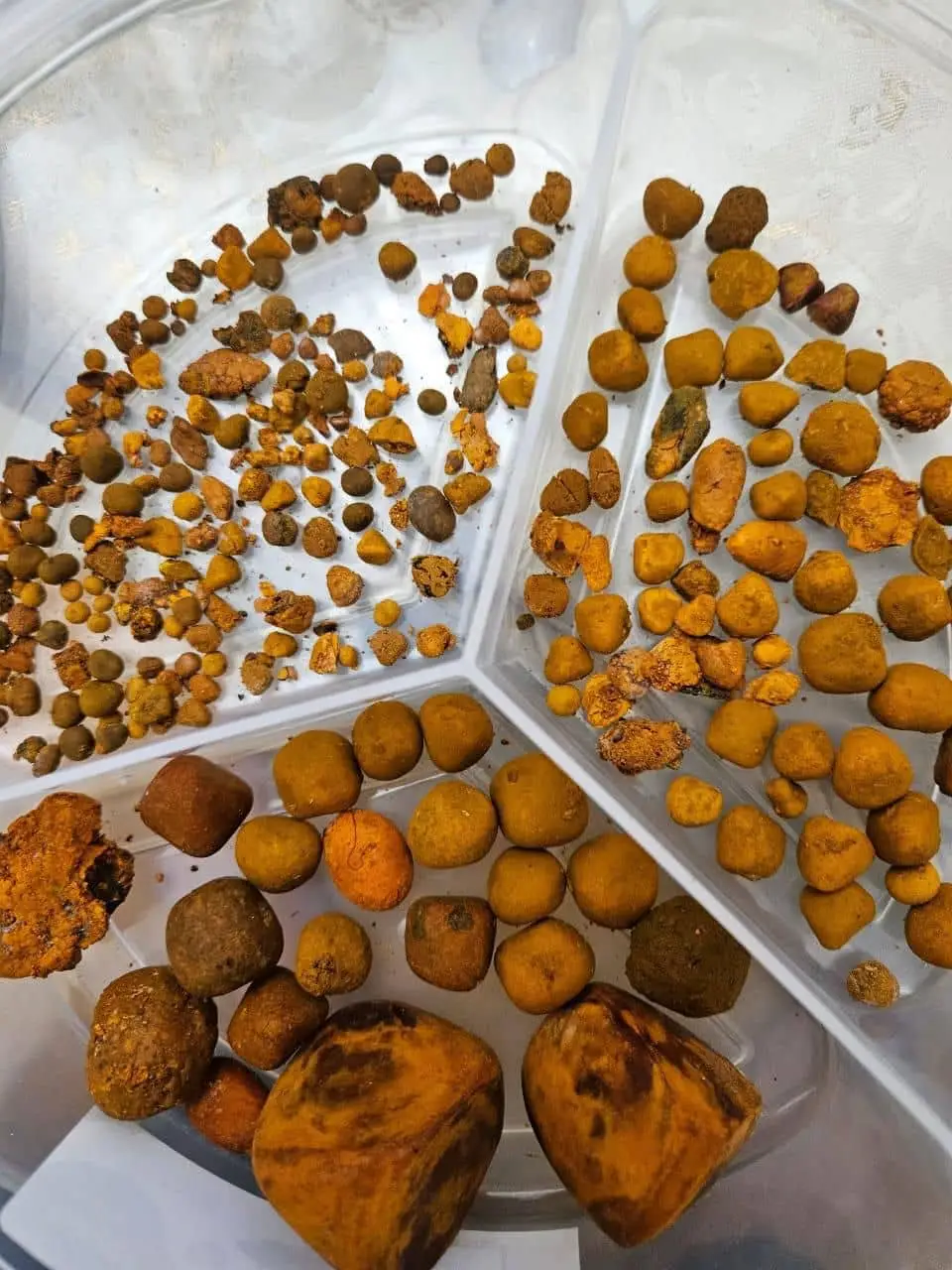 Gallstones