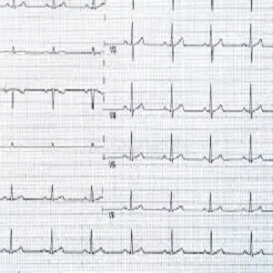 Ecg Paper